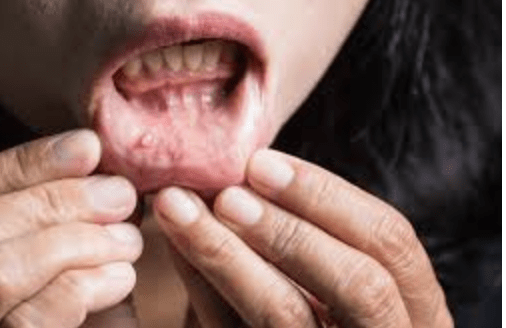 Waspada, Kenali  Sepuluh Tanda-tanda Kanker Bersemayam Dalam Tubuh