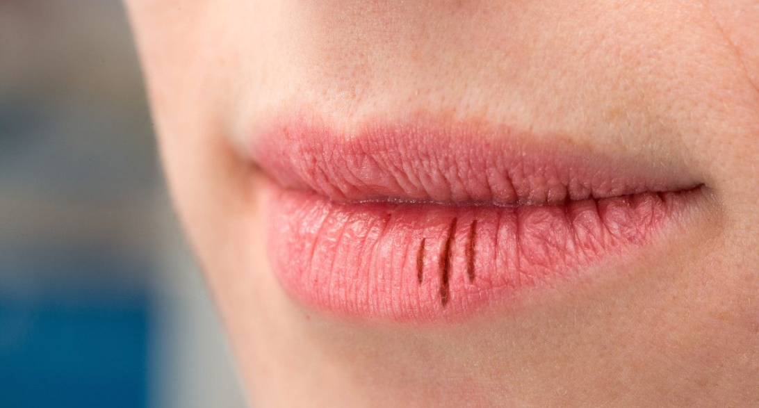 Penampakan bibir kering