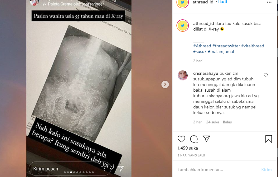 Heboh Foto X Ray Tubuh Wanita Berusia 55 tahun, Isinya Jarum Diduga Susuk