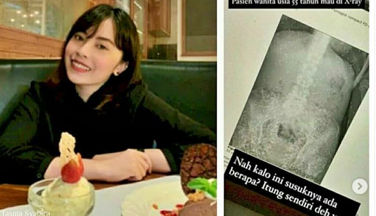 penampakan susuk pelat saat di x-ray