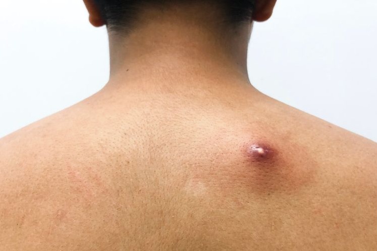 Tanaman Hias Ini Ternyata Mampu Sembuhkan Bisul, Begini Caranya