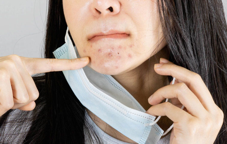Mengenal Istilah Maskne, Jerawat Akibat Pakai Masker dan Cara Mengatasinya