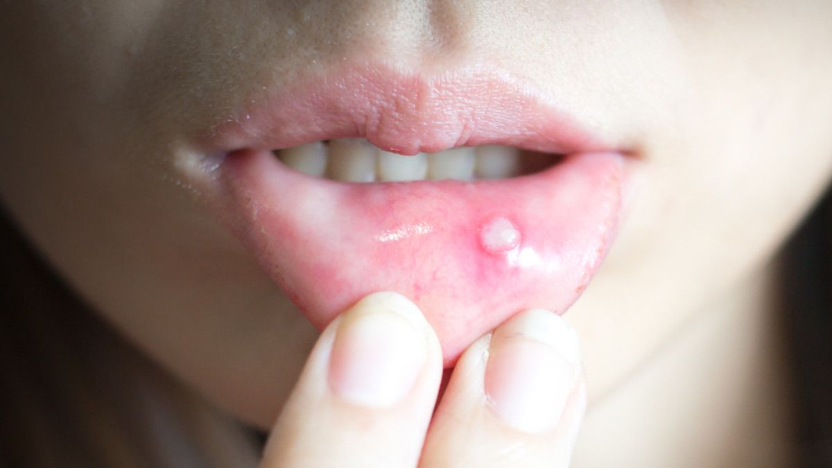 Catat!!! Ini 5 Cara Mengobati Sariawan dengan Bahan Sederhana