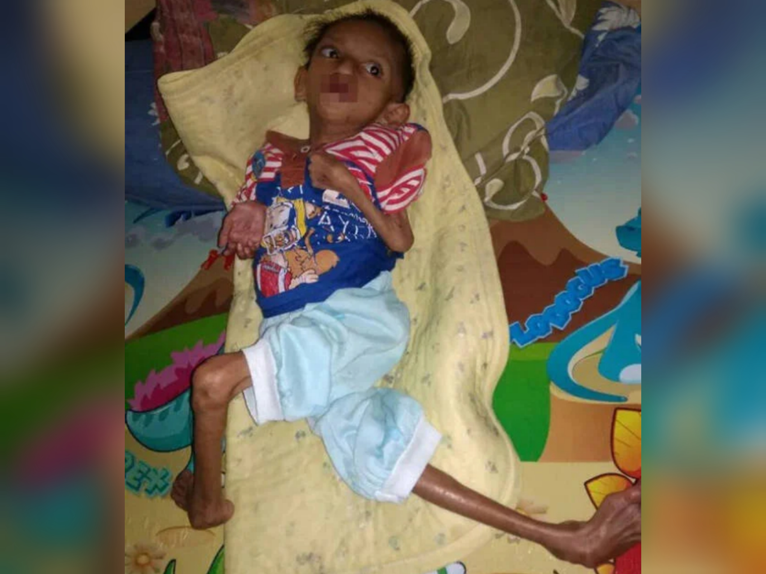 GIZI BURUK: Bocah Handayanti yang berat badannya Cuma 2 kilogram. (foto: indozone)