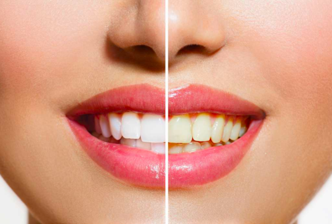 Perbandingan warna gigi sesudah (kiri) dan sebelum mengonsumsi buah-buahan. (foto: ist)