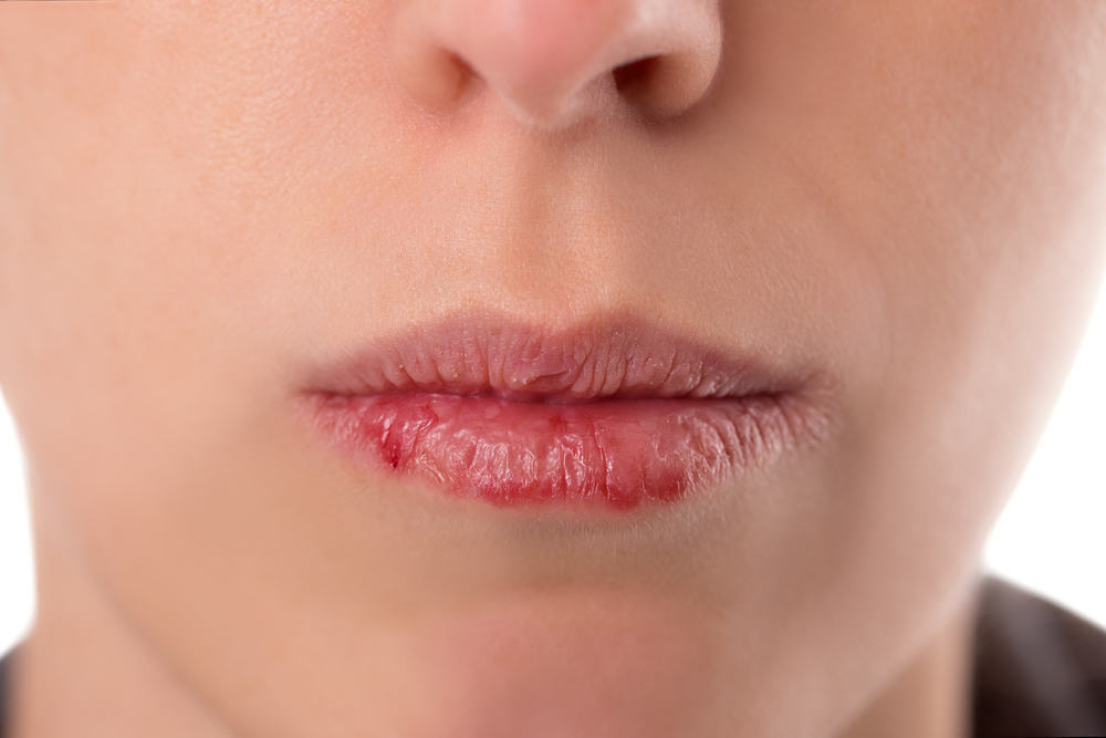 Hati-hati! Ini 7 Penyebab Bibir Kering yang Harus Dihindari