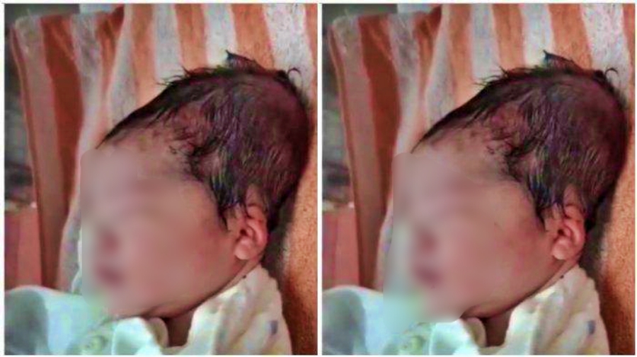 Bayi lahir dengan kondisi kepala lonjong