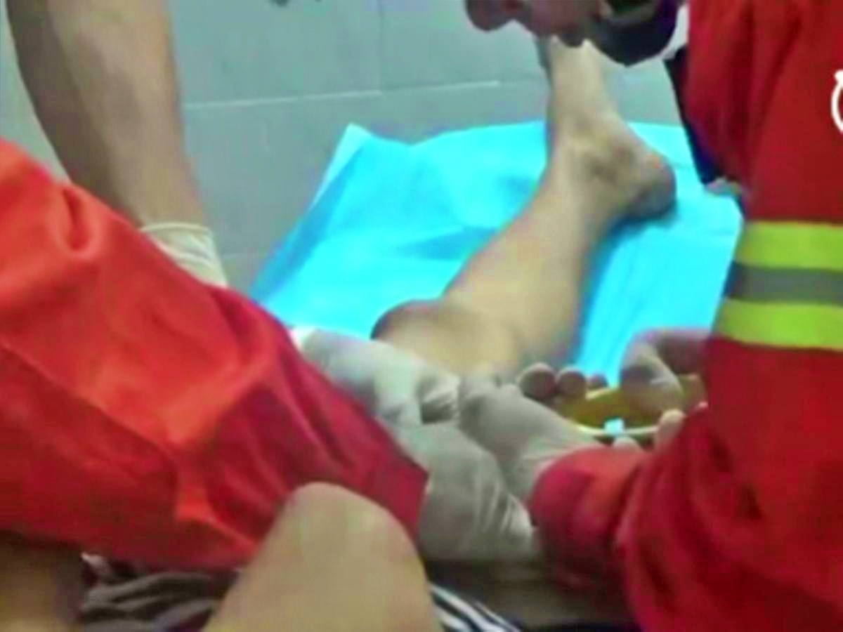 Petugas Damkar Cilacap saat berusaha melepas cincin di alat kelamin seorang duda