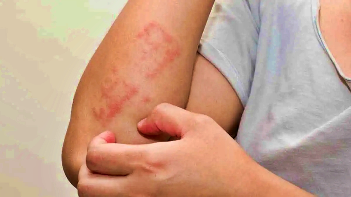 ilustrasi alergi air kenali gejala dan perawatannya