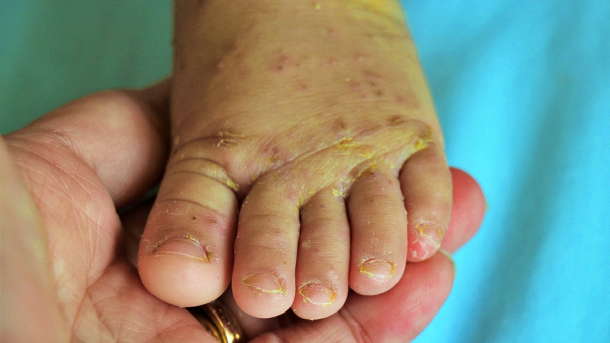 salah satu penyakit kulit sering diderita anak kecil