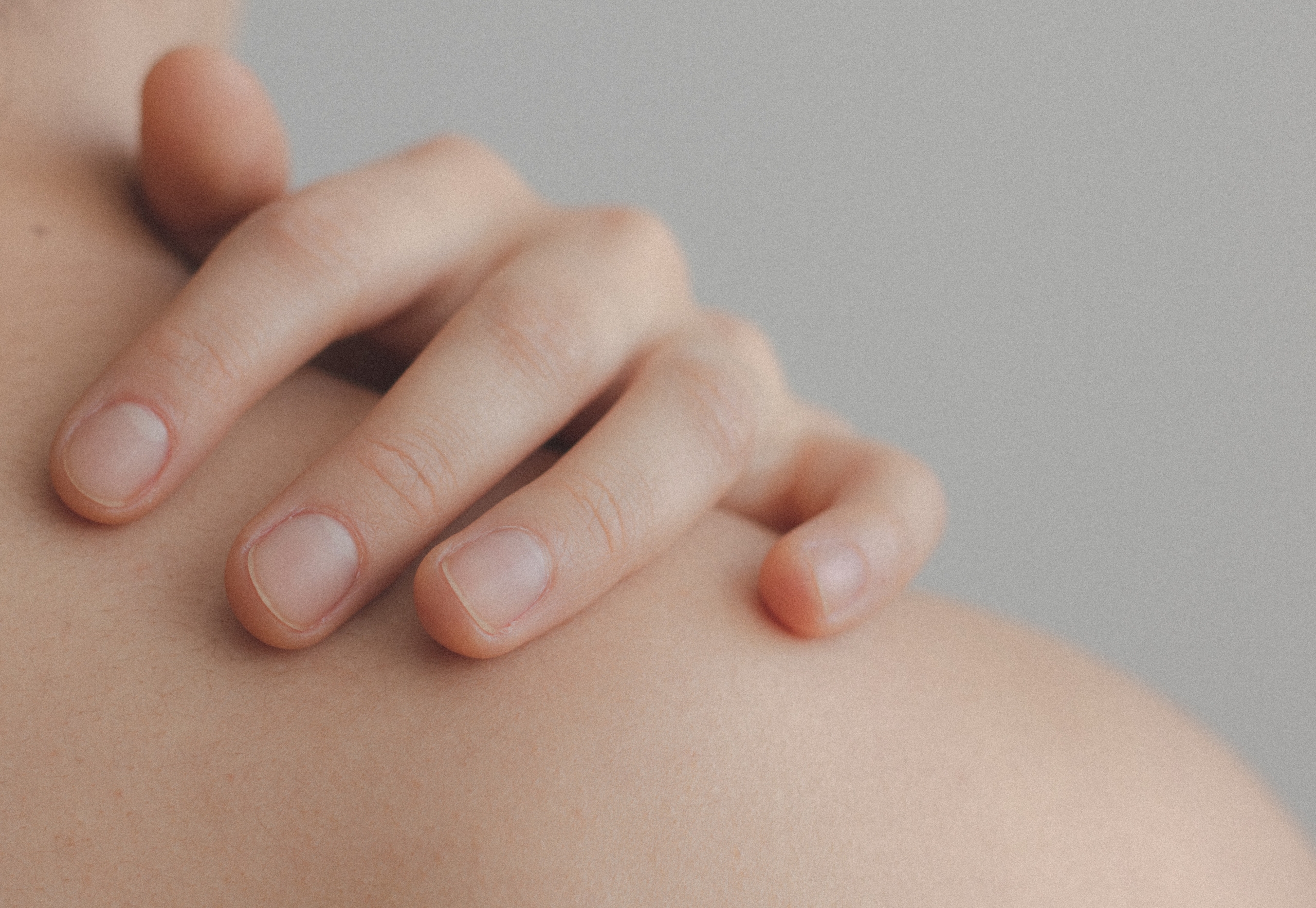 4 Cara Sederhana Merawat Kulit yang Terkena Sunburn
