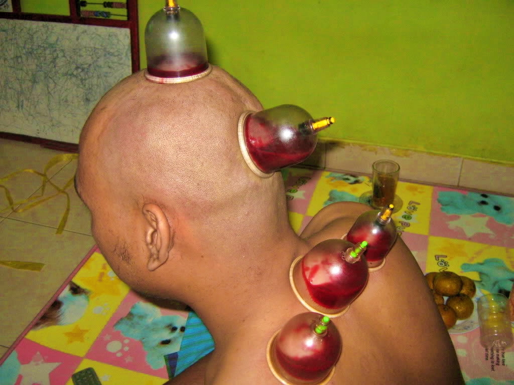 Terapi bekam untuk kesehatan