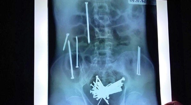 Hasil rotsen Penampakan paku dalam perut Wawan