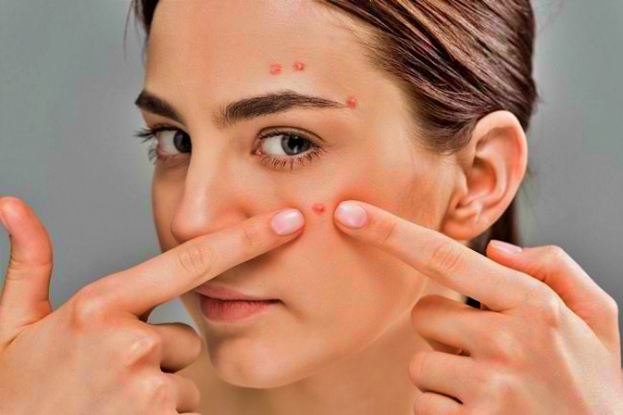 Jenis jerawat dan cara mengatasinya