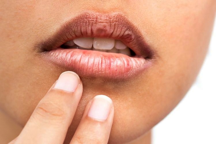 Atasi Bibir Hitam