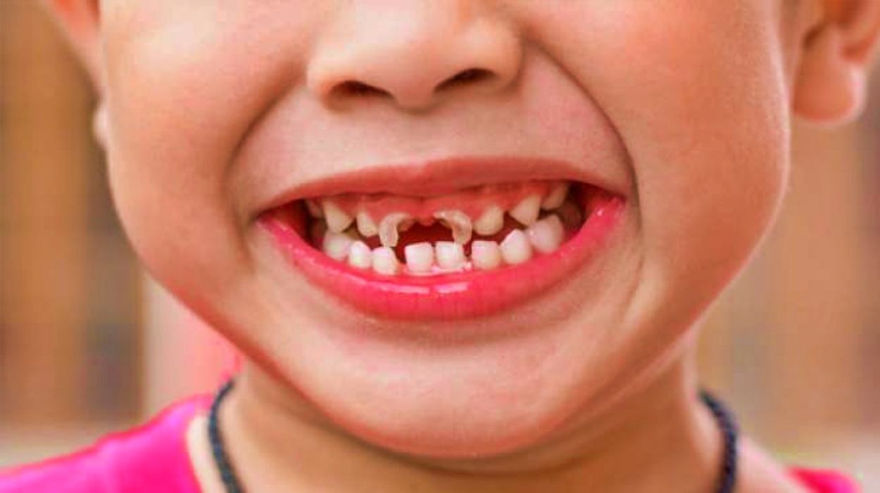 Gigi Ompong penyebab dan cara mengatasinya