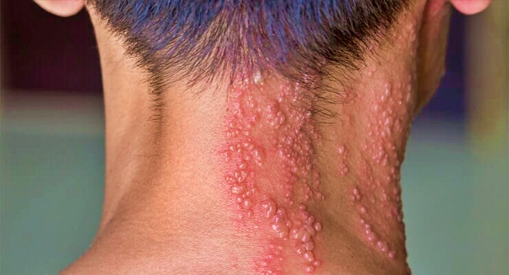 Mengenal Lebih Jauh Tentang Herpes Zoster