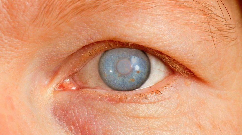 Glaukoma pada Mata